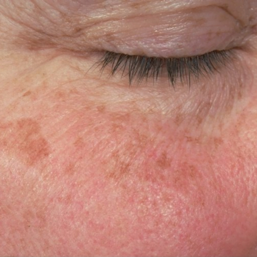 Pete hiperpigmentare 5 Lentigine solare