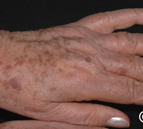 Pete hiperpigmentare 6 Lentigine solare